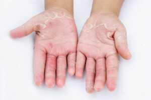 Decoding Skin Conditions: Uncovering 7 Conditions Commonly Mistaken For Scabies