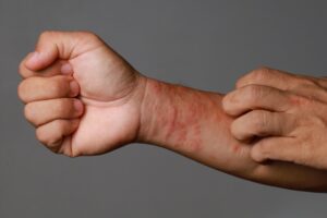 Decoding Skin Conditions: Uncovering 7 Conditions Commonly Mistaken For Scabies