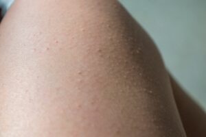 Decoding Skin Conditions: Uncovering 7 Conditions Commonly Mistaken For Scabies