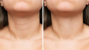 How To Get Rid Of Lines In The Neck