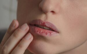 How Can I Remove Cracks‎ In The Corner Of My‎ Lips