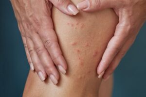 Decoding Skin Conditions: Uncovering 7 Conditions Commonly Mistaken For Scabies