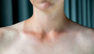 How To Get Rid Of Lines In The Neck