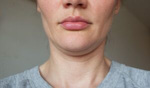 How To Get Rid Of Lines In The Neck